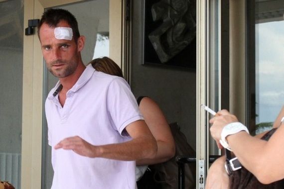 Nizozemcu liječnici ugradili tri pločice i operirali mu nos