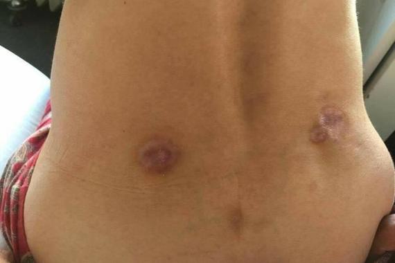 Slučaj porečke robinje: Kiselina ostavila ožiljke na leđima